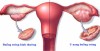 Phát hiện sớm u nang buồng trứng: Phụ nữ cần đi khám phụ khoa định kỳ