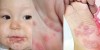 Dấu hiệu của bệnh tay chân miệng: xuất hiện mụn nước ở lòng bàn tay, lòng bàn chân, mông và bên trong miệng