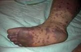Viêm não mô cầu: Chủ động phòng bệnh - phát hiện sớm - điều trị kịp thời