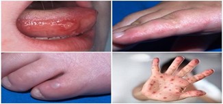 Dấu hiệu mắc tay chân miệng
